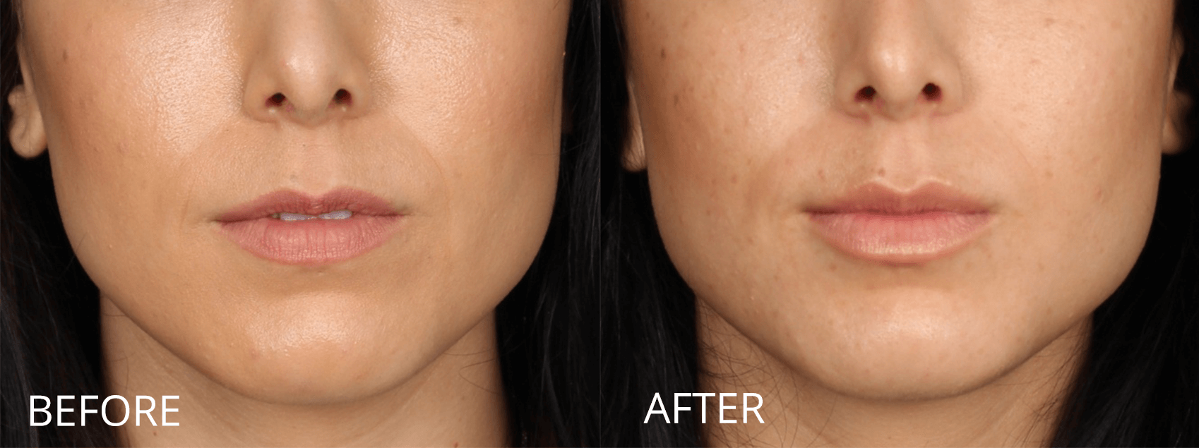 Botox And Fillers Before And Afters Raval Facial Aesthetics Denver